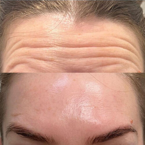 botox-before-and-after-01