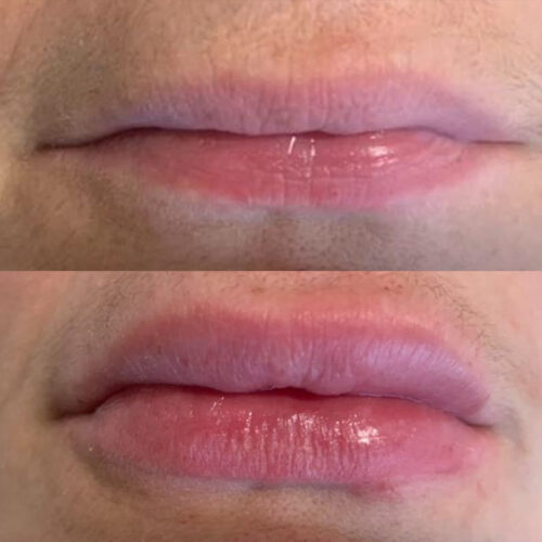 botox-before-and-after-02