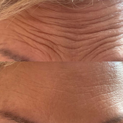 botox-before-and-after